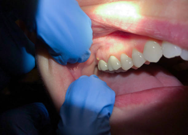 Best Emergency Treatment for Dental Infections or Abscesses in Coson, OK